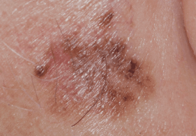 czerniak wywodzący się z plamy soczewicowatej LMM