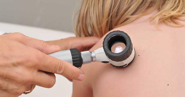 Dermatoskopia klasyczna - lekarz bada znamię dermatoskopem ręcznym bez możliwości cyfrowej archiwizacji obrazu