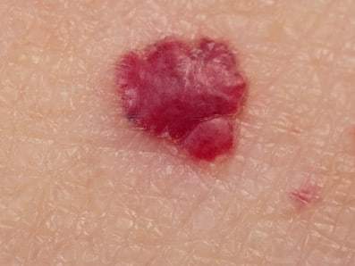 Naczyniak starczy rubinowy - cherry angioma senile angioma zdjęcie dermatologiczne
