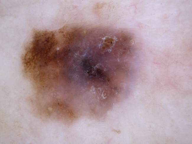 Czerniak skóry - melanoma badanie histopatologiczne blizna po wycięciu