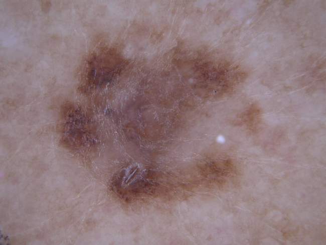 Czerniak skóry - melanoma przerzuty węzły chłonne zdjęcie kliniczne