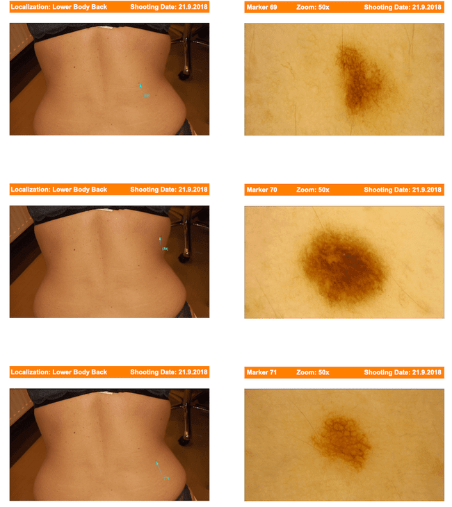 Raport badania wideodermatoskopowego u jednej z naszych pacjentek.