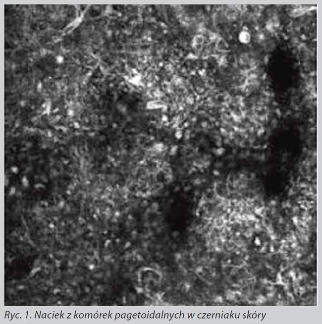 diagnostyka czerniaka skóry z wykorzystaniem refleksyjnej mikroskopii konfokalnej