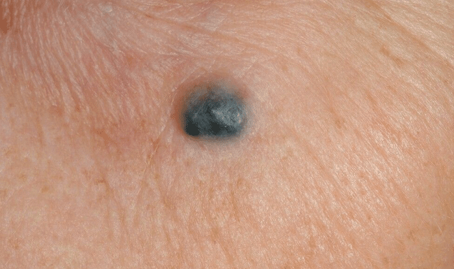 Znamię błękitne - blue nevus szaroniebieskie znamię diagnostyka różnicowa czerniak