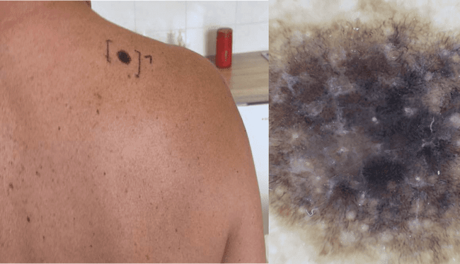 Czerniak złośliwy - melanoma nowotwór barwnikowy zdjęcie medyczne