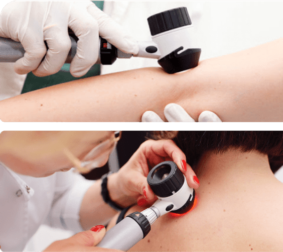 Dermatoskopia znamion i pieprzyków Dermatoskopia znamion i pieprzyków