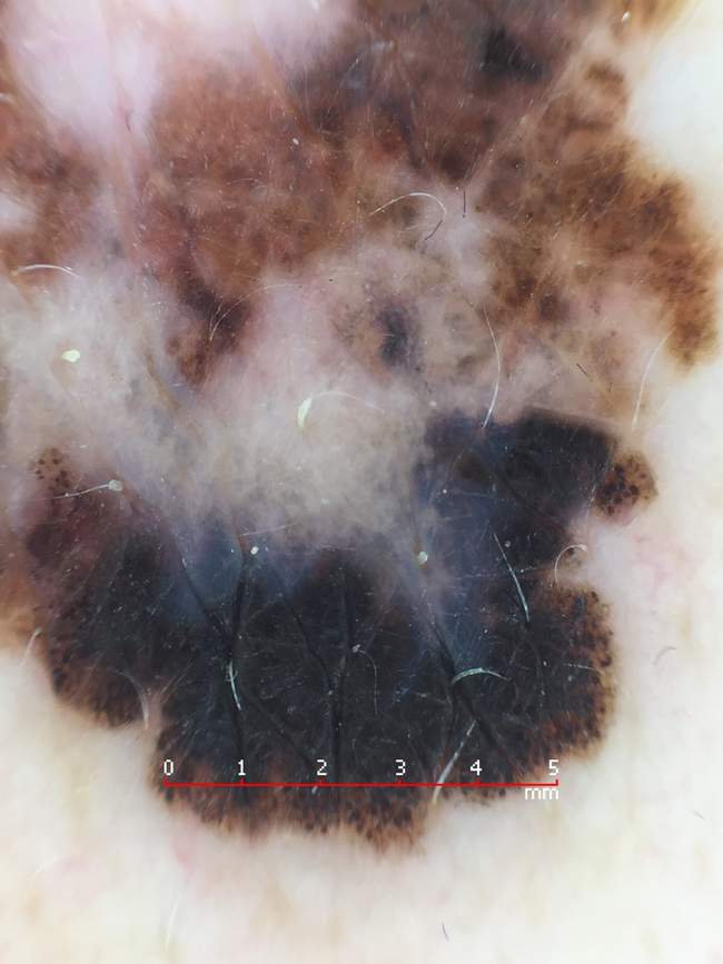 Klasyczny dermatoskopowy obraz czerniaka