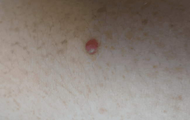 Czerniak bezbarwnikowy