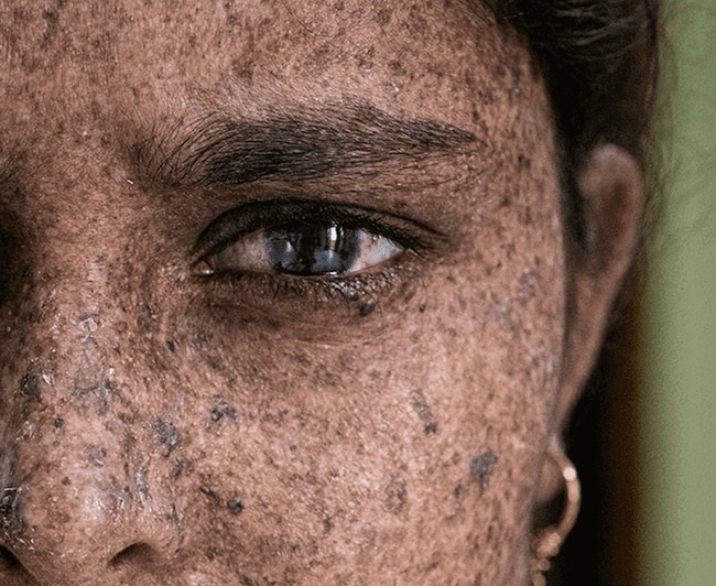 zespół znamion dysplastycznych - atypowych