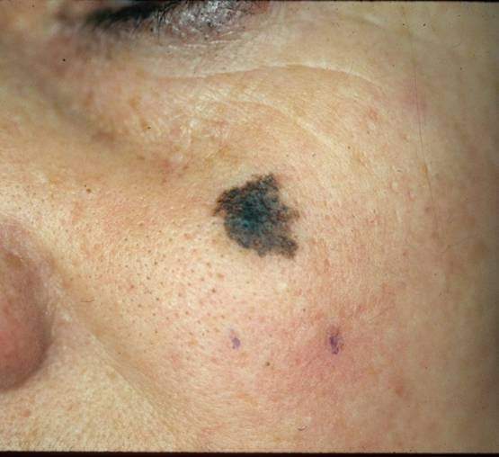 Czerniak skóry - melanoma zdjęcie medyczne nowotwór barwnikowy