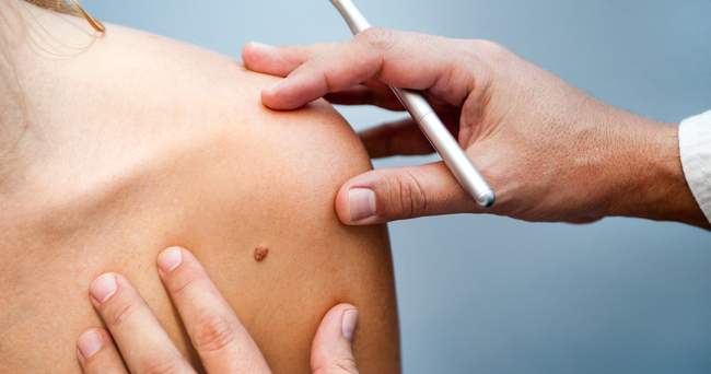 Rodzaje znamion barwnikowych.