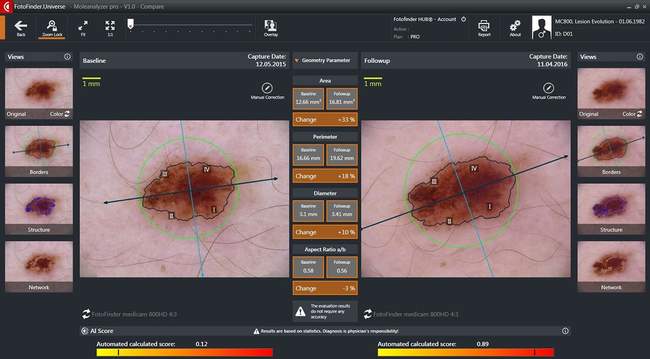 MoleAnalyzer Pro - system komputerowej oceny znamion AI sztuczna inteligencja wspomaganie diagnozy czerniaka wideodermatoskopia