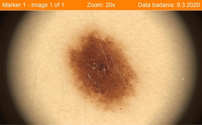 Znamię barwnikowe mikroskopowo - obraz dermatoskopowy w powiększeniu 50x podczas badania wideodermatoskopowego