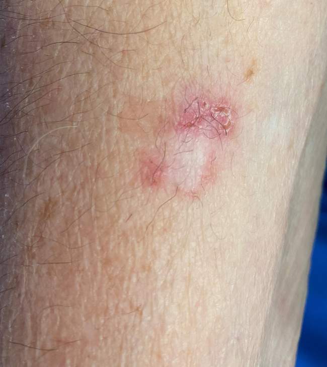 Rak podstawnokomórkowy - objawy