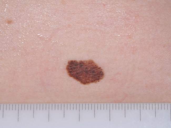 Czerniak skóry - melanoma badanie histopatologiczne węzeł wartowniczy zdjęcie