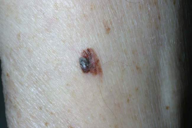 Czerniak skóry - melanoma zdjęcie dermatologiczne nowotwór barwnikowy