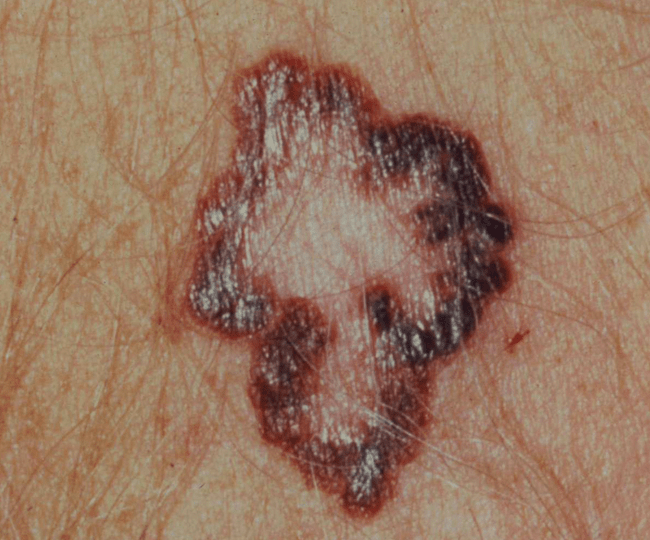 Regresja - objaw czerniaka