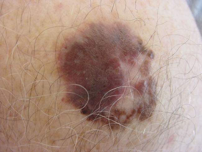 Czerniak skóry - melanoma nawrót choroby zdjęcie kliniczne