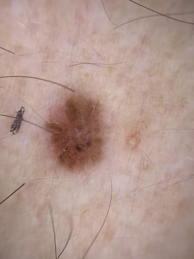 Obraz dermatoskopowy rak podstawnokomórkowego