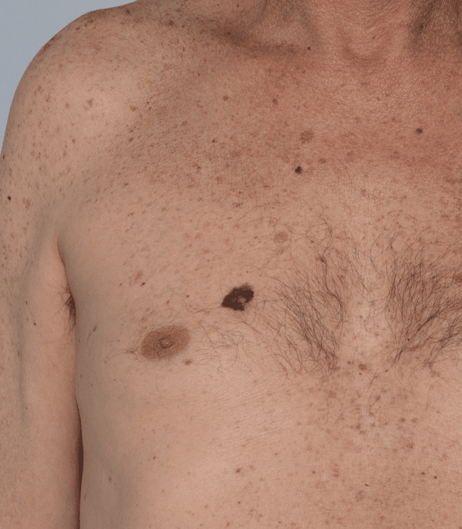 Objaw brzydkigo kaczątka - objaw czerniaka.