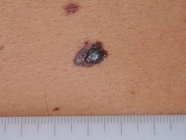 Czerniak skóry - melanoma zdjęcie kliniczne nowotwór barwnikowy