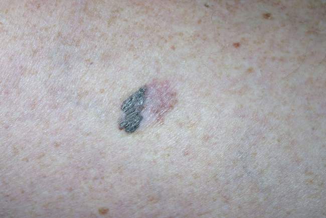 Czerniak skóry - nowotwór barwnikowy melanocytów zdjęcie dermatologiczne