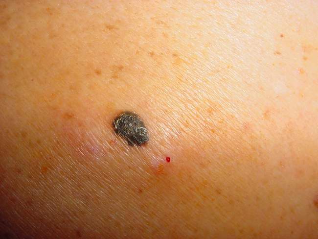 Czerniak skóry - melanoma zdjęcie kliniczne nowotwór barwnikowy