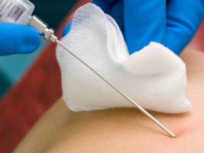 Strzykawka i igła używa do biopsji cienkoigłowej. 