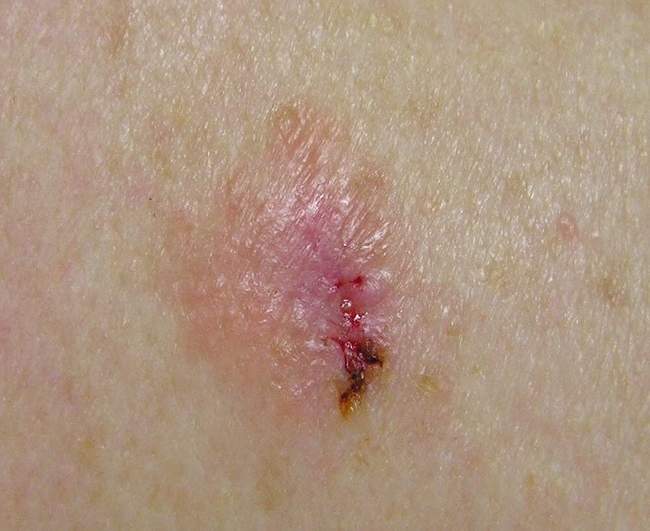 Czerniak bezbarwnikowy