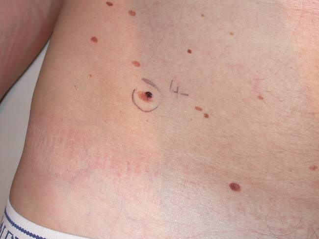 Czerniak skóry - melanoma zdjęcie dermatologiczne przykład kliniczny