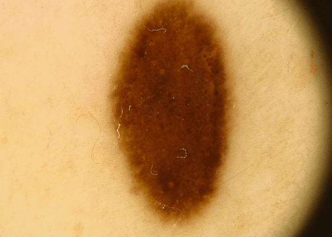 Wideodermatoskopia - zmapowane znamię nr 40.