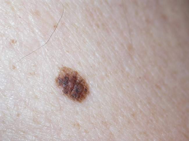 Czerniak skóry - melanoma zdjęcie kliniczne nowotwór barwnikowy objawy