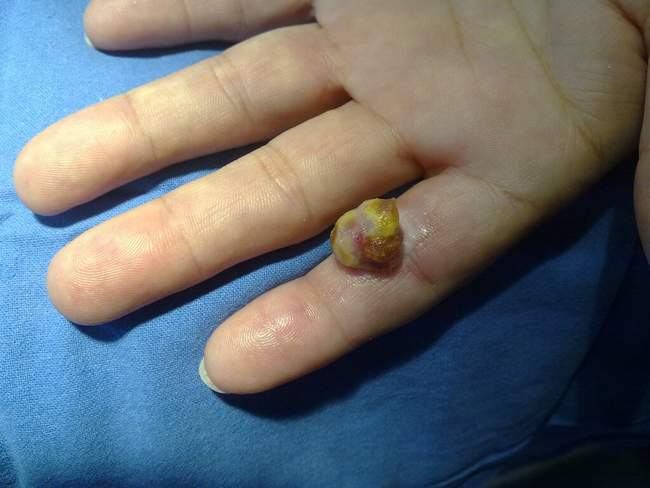 Czerniak guzkowaty - nodular melanoma zdjęcie kliniczne postać guzkowa