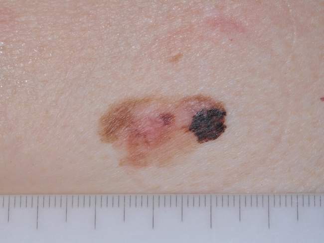Czerniak skóry - melanoma przerzuty węzeł wartowniczy zdjęcie medyczne