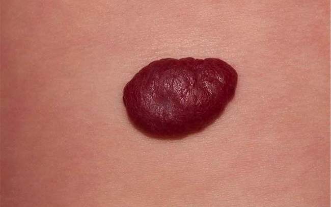 Naczyniak jamisty - hemangioma cavernosum łagodny guz naczyniowy zdjęcie dermatologiczne